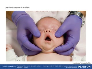 Prehospital Emergency Care, 10th
edition
Mistovich | Karren
Copyright © 2014, 2010, 2008 by Pearson Education, Inc.
All Rights Reserved
Jaw-thrust maneuver in an infant.
continued on next slide
 