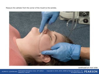 Prehospital Emergency Care, 10th
edition
Mistovich | Karren
Copyright © 2014, 2010, 2008 by Pearson Education, Inc.
All Rights Reserved
Measure the catheter from the corner of the mouth to the earlobe.
continued on next slide
 