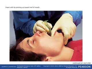 Prehospital Emergency Care, 10th
edition
Mistovich | Karren
Copyright © 2014, 2010, 2008 by Pearson Education, Inc.
All Rights Reserved
Insert with tip pointing up toward roof of mouth.
continued on next slide
 