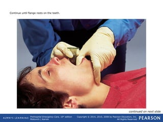 Prehospital Emergency Care, 10th
edition
Mistovich | Karren
Copyright © 2014, 2010, 2008 by Pearson Education, Inc.
All Rights Reserved
Continue until flange rests on the teeth.
continued on next slide
 