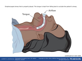 Prehospital Emergency Care, 10th
edition
Mistovich | Karren
Copyright © 2014, 2010, 2008 by Pearson Education, Inc.
All Rights Reserved
Oropharyngeal airway that is properly placed. The tongue is kept from falling back to occlude the patient’s airway.
continued on next slide
 