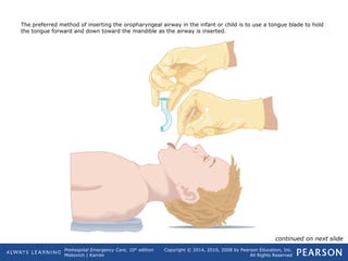 Prehospital Emergency Care, 10th
edition
Mistovich | Karren
Copyright © 2014, 2010, 2008 by Pearson Education, Inc.
All Rights Reserved
The preferred method of inserting the oropharyngeal airway in the infant or child is to use a tongue blade to hold
the tongue forward and down toward the mandible as the airway is inserted.
continued on next slide
 