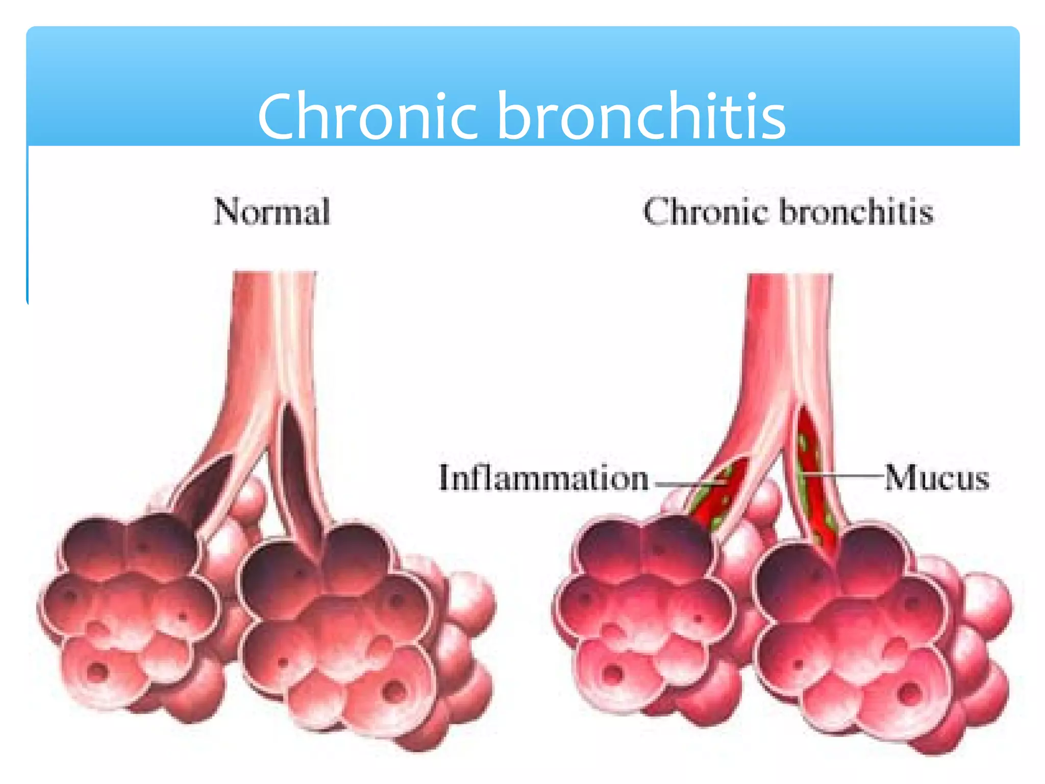 ∗Due to prolonged breathing of irritants
Chronic bronchitis
 