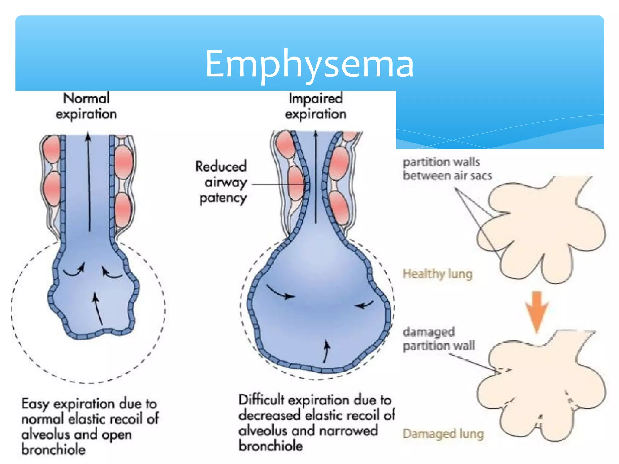 ∗Due to persistent and violent coughing
Emphysema
 