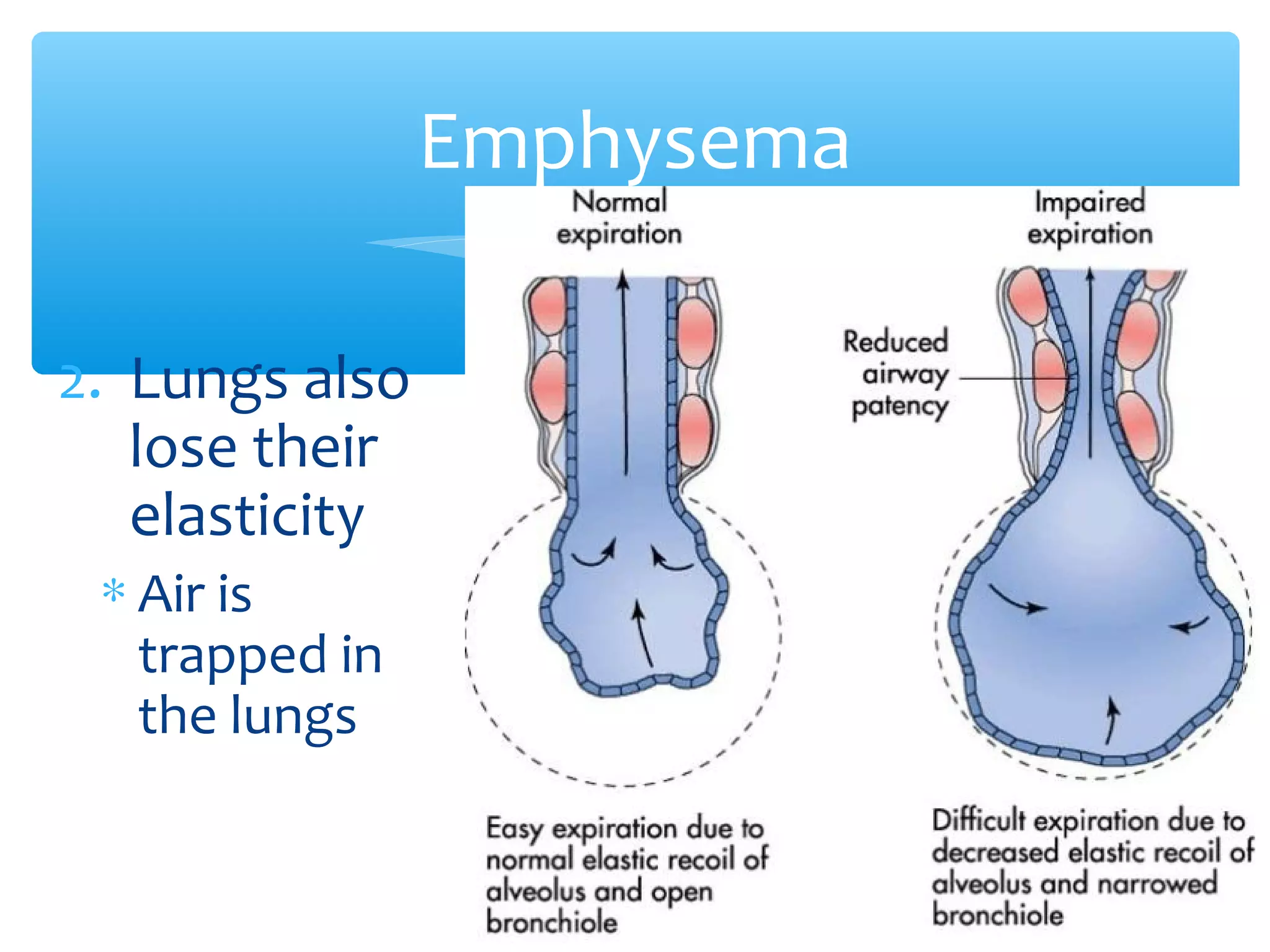 2. Lungs also
lose their
elasticity
∗ Air is
trapped in
the lungs
Emphysema
 