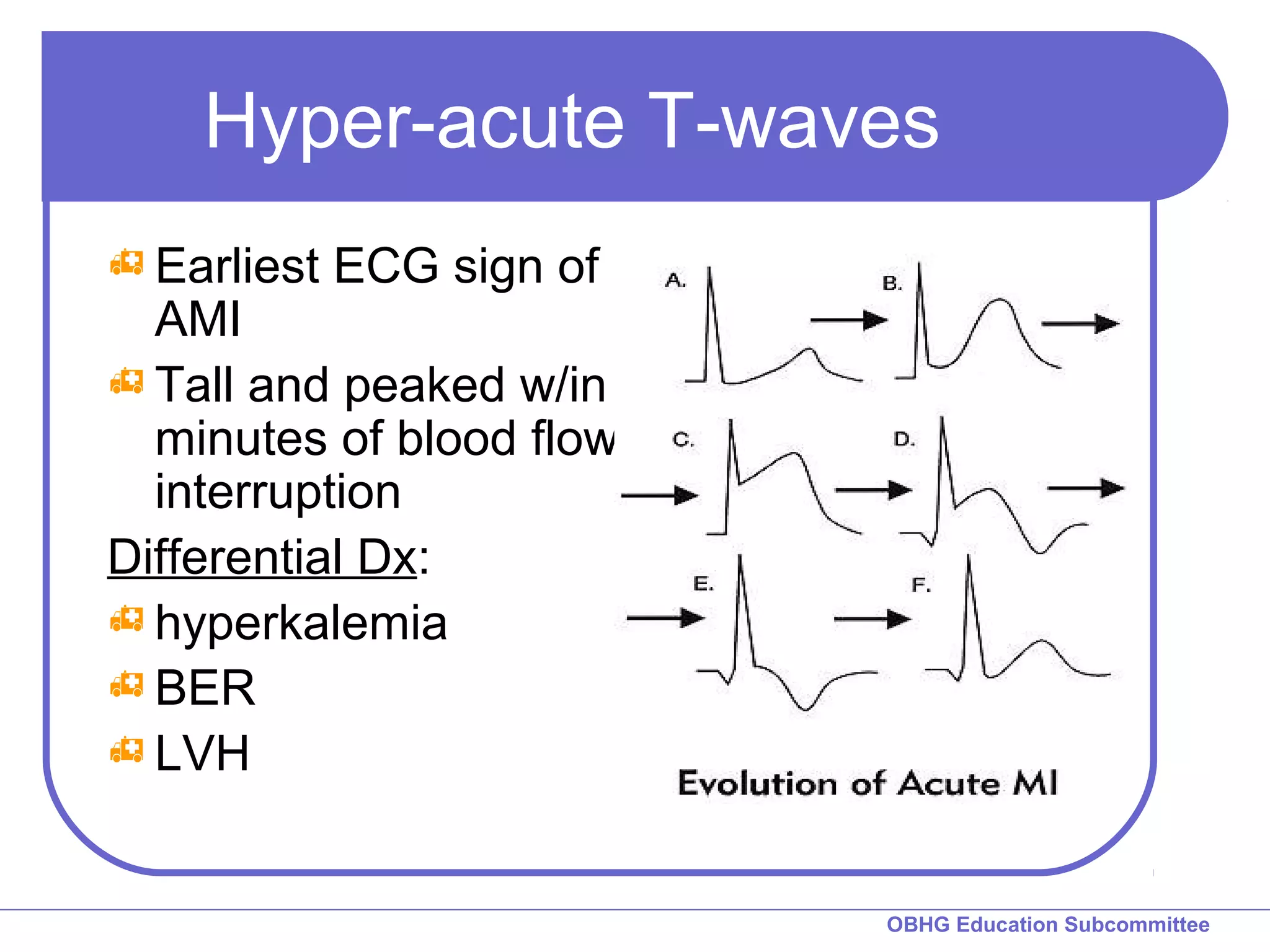 Hyper-acute T-waves 
OBHG Education Subcommittee 
Earliest ECG sign of 
AMI 
Tall and peaked w/in 
minutes of blood flow 
interruption 
Differential Dx: 
hyperkalemia 
BER 
LVH 
 
