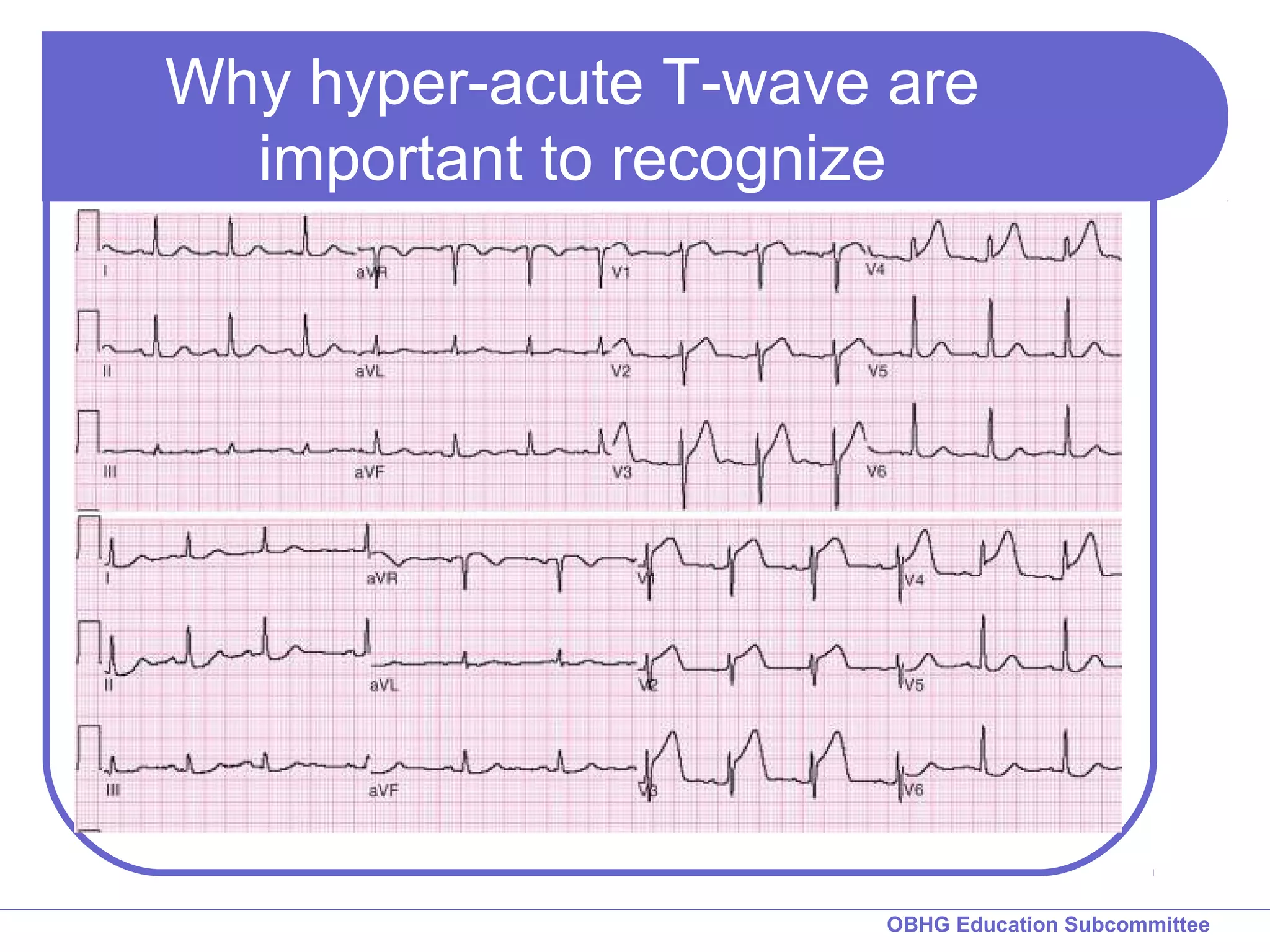 Why hyper-acute T-wave are 
OBHG Education Subcommittee 
important to recognize 
 
