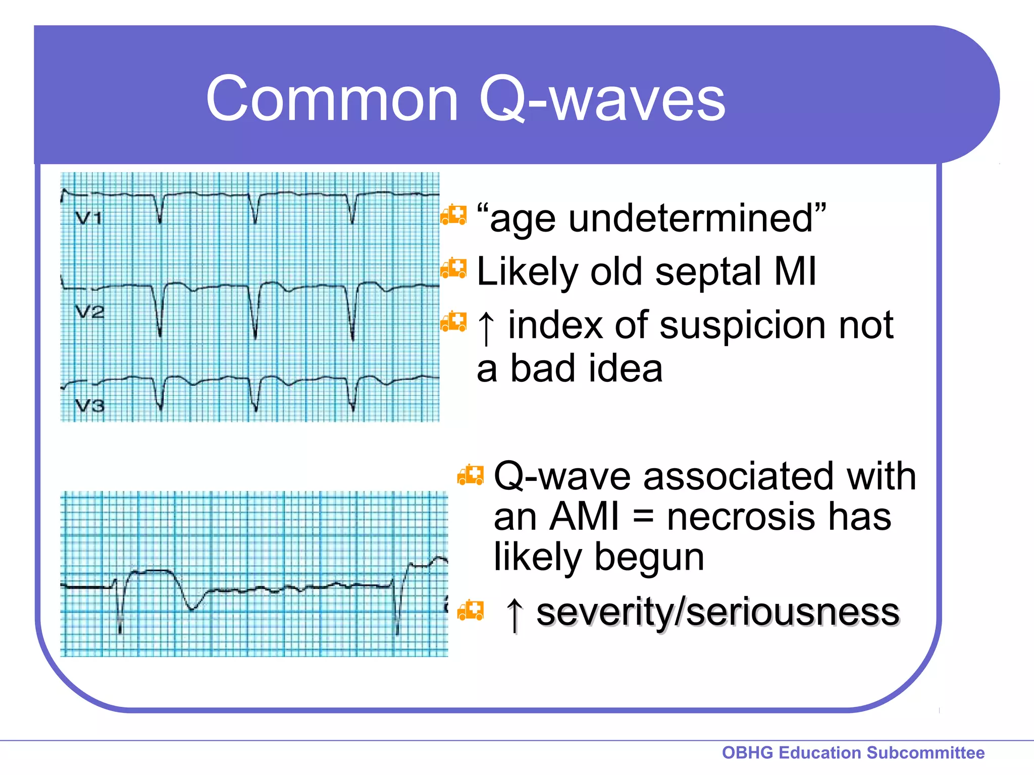 Common Q-waves 
“age undetermined” 
Likely old septal MI 
↑ index of suspicion not 
a bad idea 
Q-wave associated with 
an AMI = necrosis has 
likely begun 
 ↑↑ sseevveerriittyy//sseerriioouussnneessss 
OBHG Education Subcommittee 
 