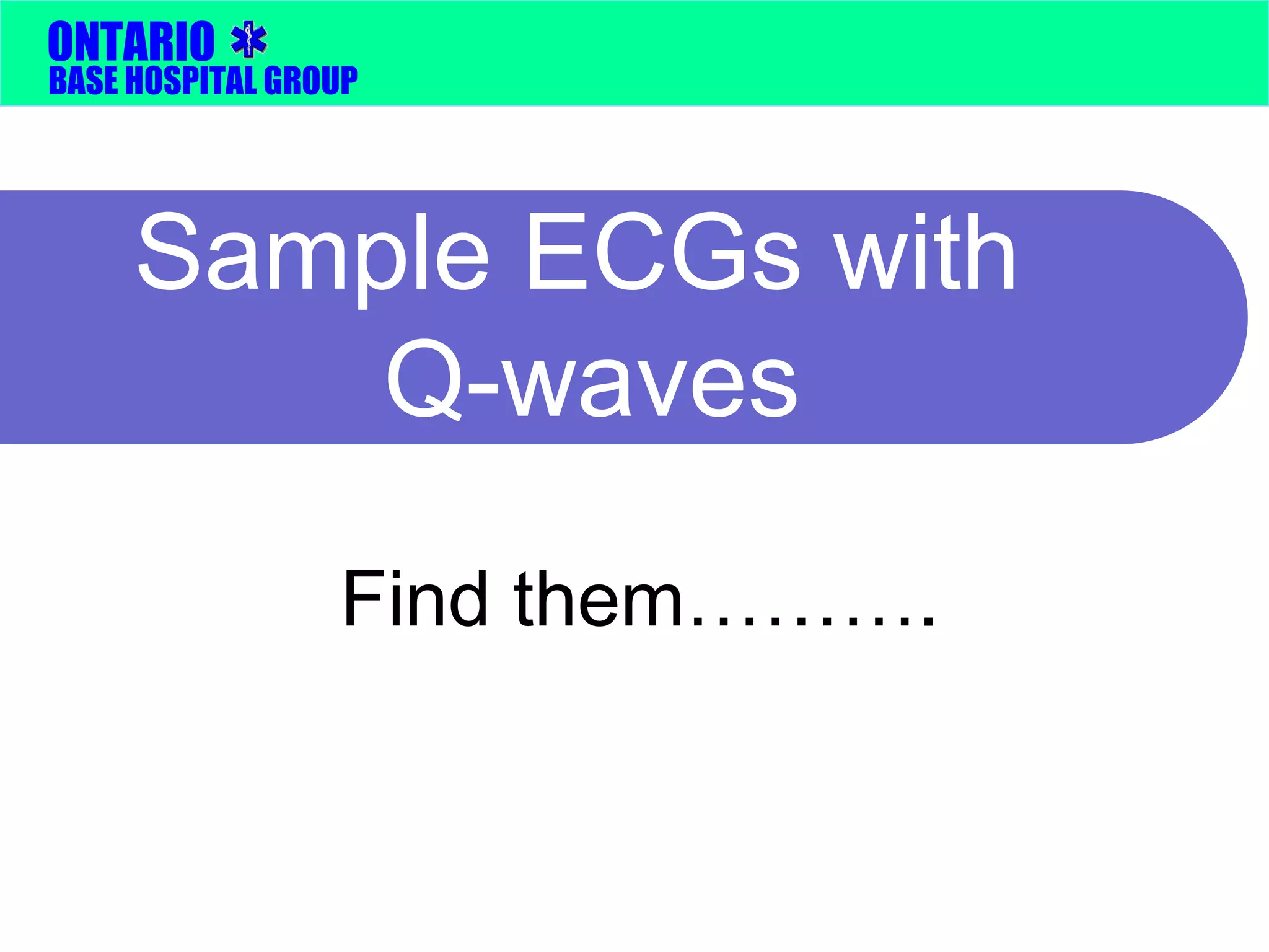 ONTARIO 
BASE HOSPITAL GROUP 
Sample ECGs with 
Q-waves 
Find them………. 
 