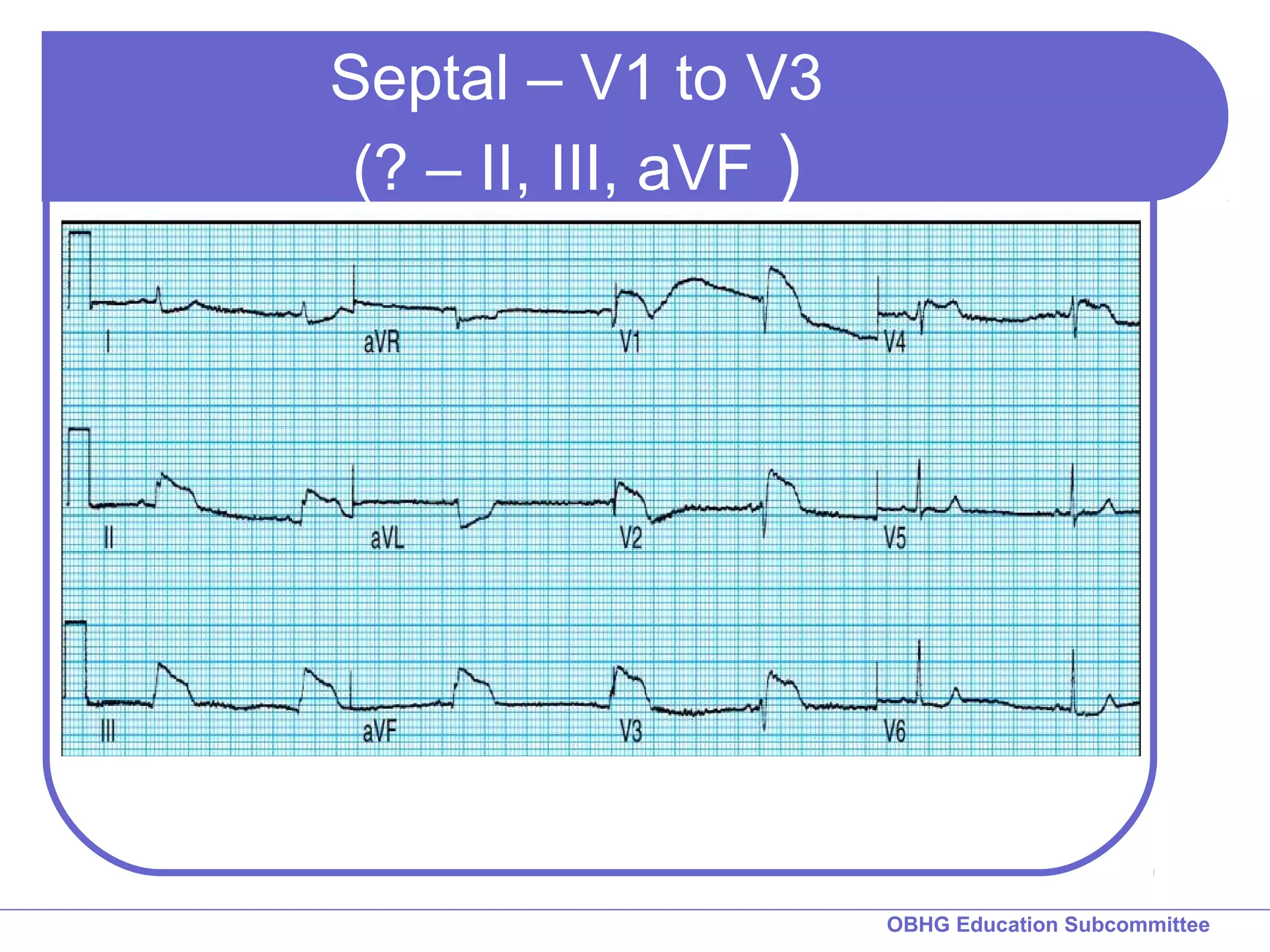 OBHG Education Subcommittee 
Septal – V1 to V3 
(? – II, III, aVF ) 
 