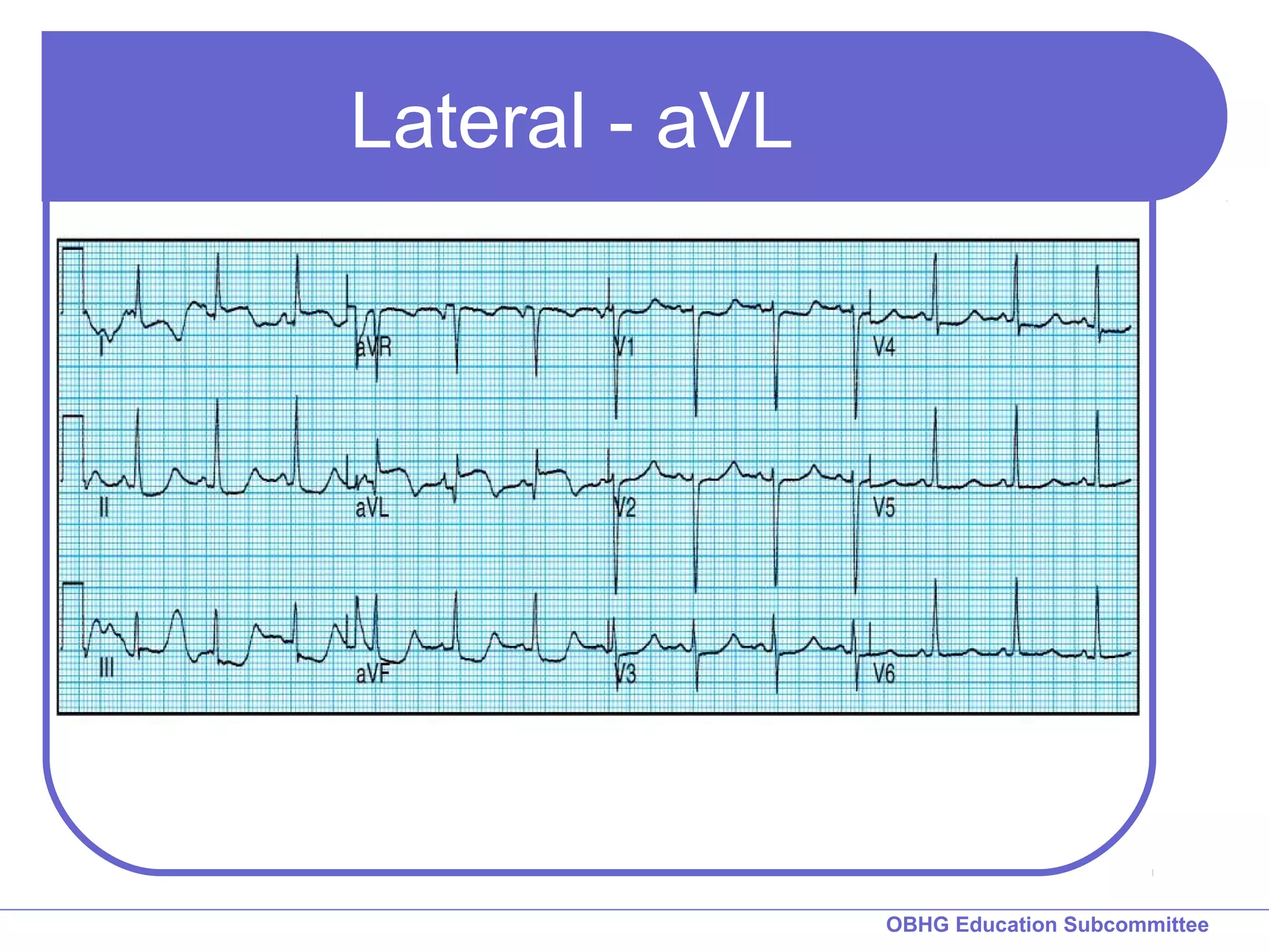 OBHG Education Subcommittee 
Lateral - aVL 
 