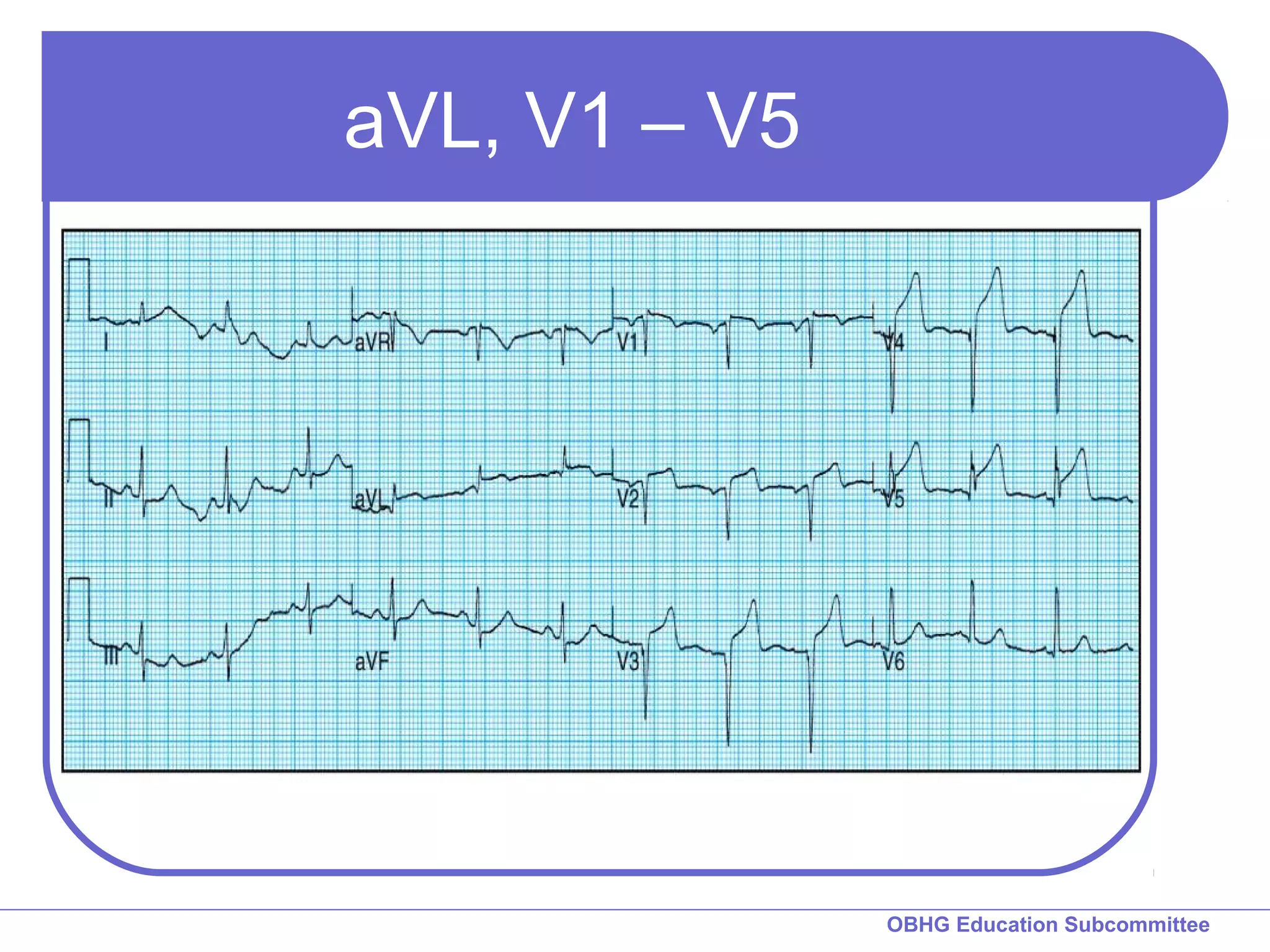 OBHG Education Subcommittee 
aVL, V1 – V5 
 
