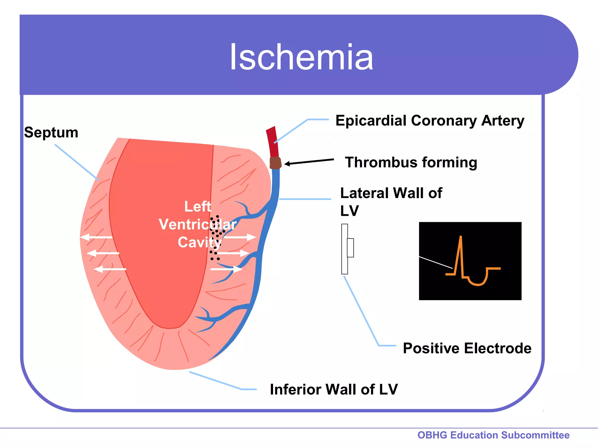 Ischemia 
Epicardial Coronary Artery 
Thrombus forming 
Lateral Wall of 
LV 
Positive Electrode 
OBHG Education Subcommittee 
Septum 
Left 
Ventricular 
Cavity 
Inferior Wall of LV 
 