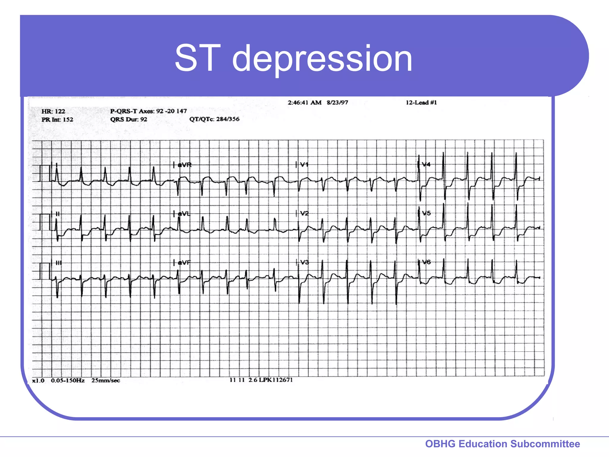 OBHG Education Subcommittee 
ST depression 
 