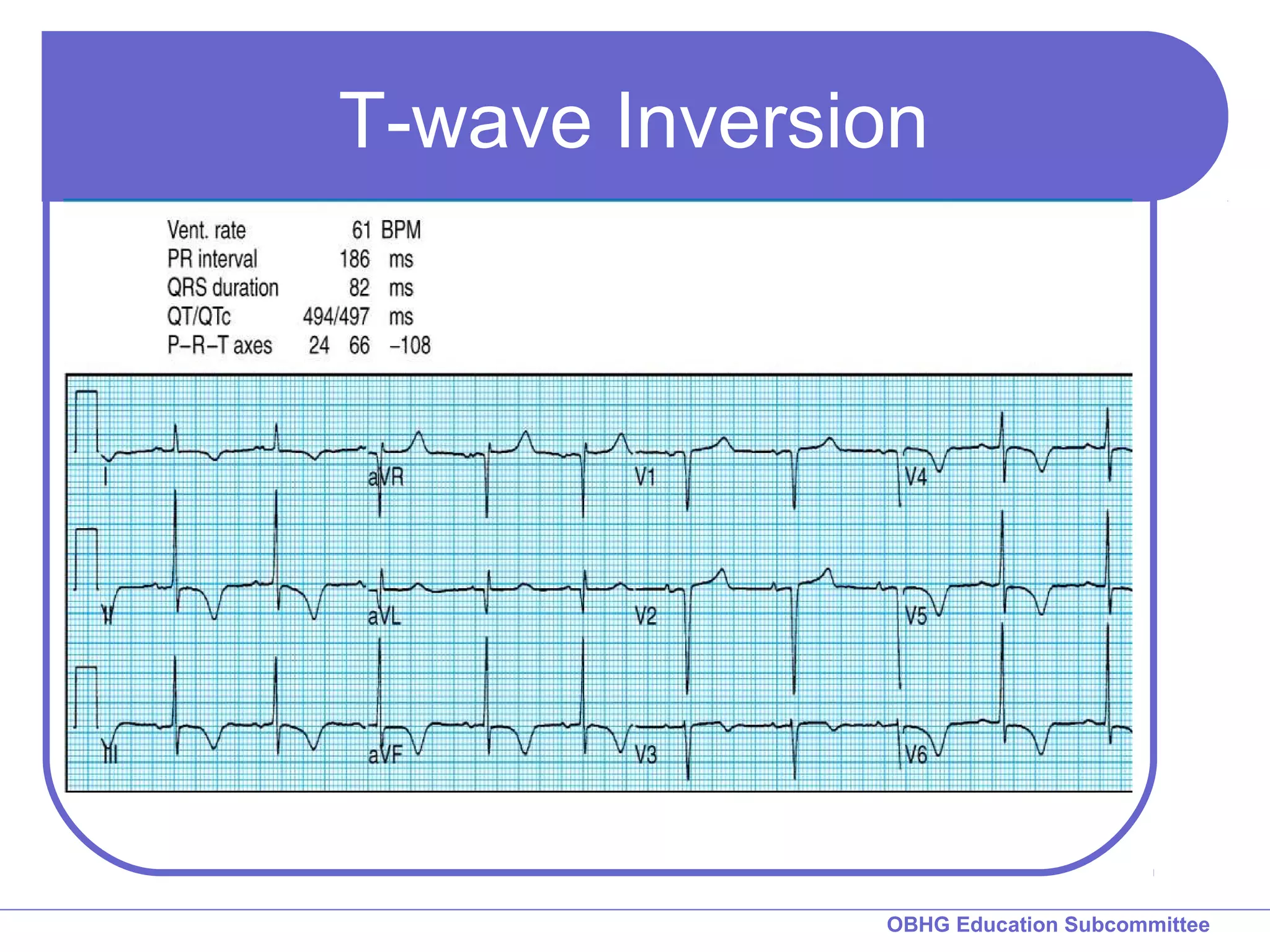 T-wave Inversion 
OBHG Education Subcommittee 
 