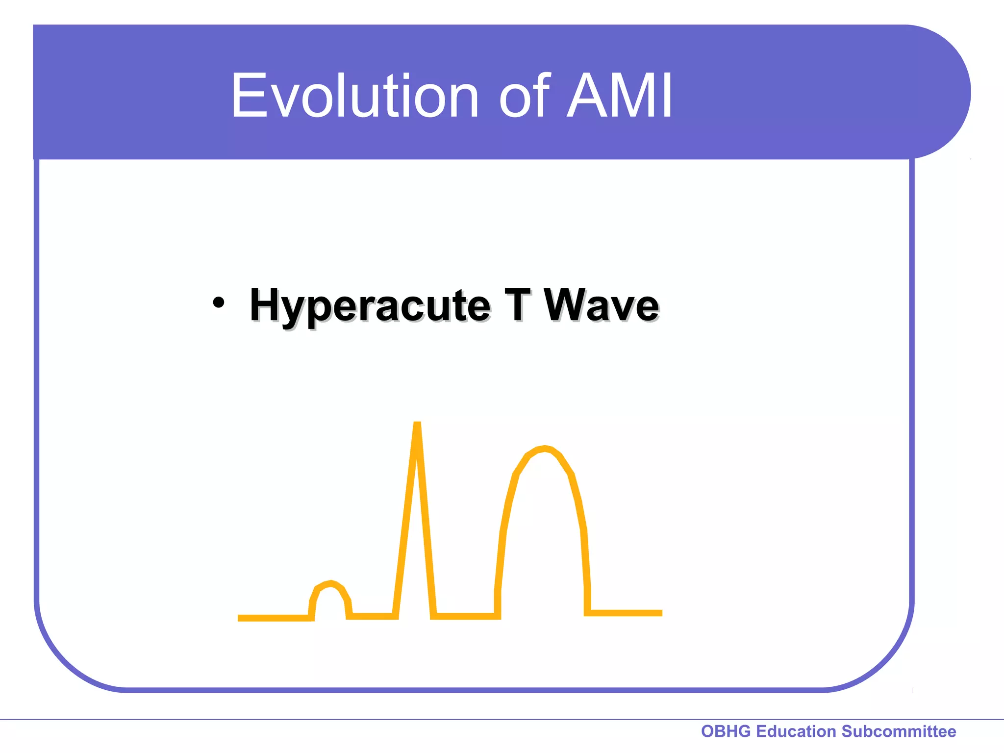 OBHG Education Subcommittee 
Evolution of AMI 
• HHyyppeerraaccuuttee TT WWaavvee 
 