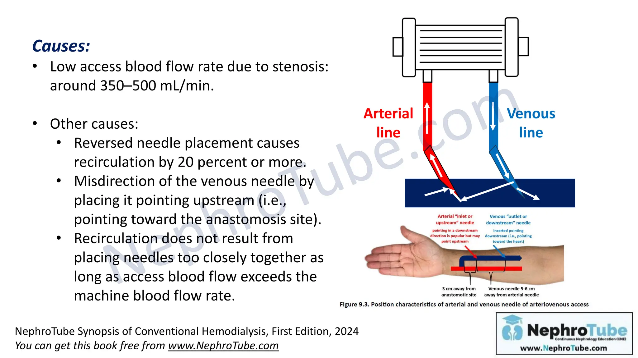 Hemodialysis: Chapter 10, AVF and AVG - Complications (Diagnosis and ...