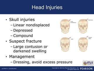 Skull Potential Injuries Chapter10 head trauma | PPT