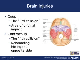 Chop Algorithm Concussion Chapter10 head trauma | PPT