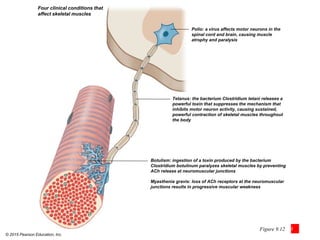 © 2015 Pearson Education, Inc.
Figure 9.12 3
Four clinical conditions that
affect skeletal muscles
Polio: a virus affects motor neurons in the
spinal cord and brain, causing muscle
atrophy and paralysis
Tetanus: the bacterium Clostridium tetani releases a
powerful toxin that suppresses the mechanism that
inhibits motor neuron activity, causing sustained,
powerful contraction of skeletal muscles throughout
the body
Botulism: ingestion of a toxin produced by the bacterium
Clostridium botulinum paralyzes skeletal muscles by preventing
ACh release at neuromuscular junctions
Myasthenia gravis: loss of ACh receptors at the neuromuscular
junctions results in progressive muscular weakness
 