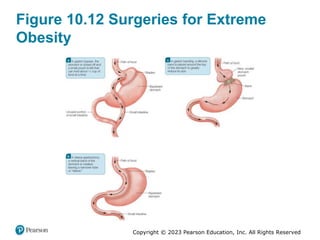 Copyright © 2023 Pearson Education, Inc. All Rights Reserved
Figure 10.12 Surgeries for Extreme
Obesity
 