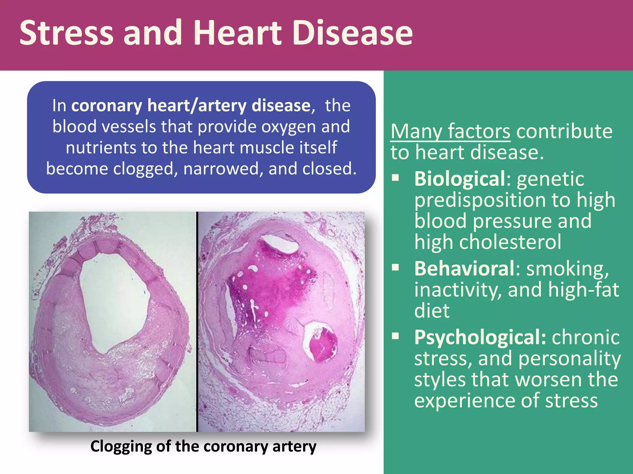 Stress and Heart Disease
In coronary heart/artery disease, the
blood vessels that provide oxygen and
nutrients to the heart muscle itself
become clogged, narrowed, and closed.

Clogging of the coronary artery

Many factors contribute
to heart disease.
 Biological: genetic
predisposition to high
blood pressure and
high cholesterol
 Behavioral: smoking,
inactivity, and high-fat
diet
 Psychological: chronic
stress, and personality
styles that worsen the
experience of stress

 