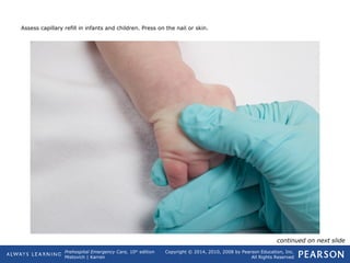 Prehospital Emergency Care, 10th
edition
Mistovich | Karren
Copyright © 2014, 2010, 2008 by Pearson Education, Inc.
All Rights Reserved
Assess capillary refill in infants and children. Press on the nail or skin.
continued on next slide
 
