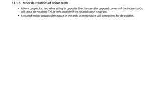 11.1.6 Minor de-rotations of incisor teeth
• A force couple, i.e. two wires acting in opposite directions on the opposed corners of the incisor tooth,
will cause de-rotation. This is only possible if the rotated tooth is upright.
• A rotated incisor occupies less space in the arch, so more space will be required for de-rotation.
 