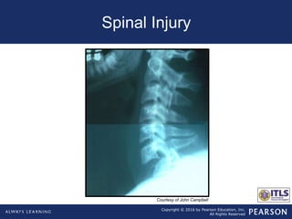 Copyright © 2016 by Pearson Education, Inc.
All Rights Reserved
Spinal Injury
Courtesy of John Campbell
 