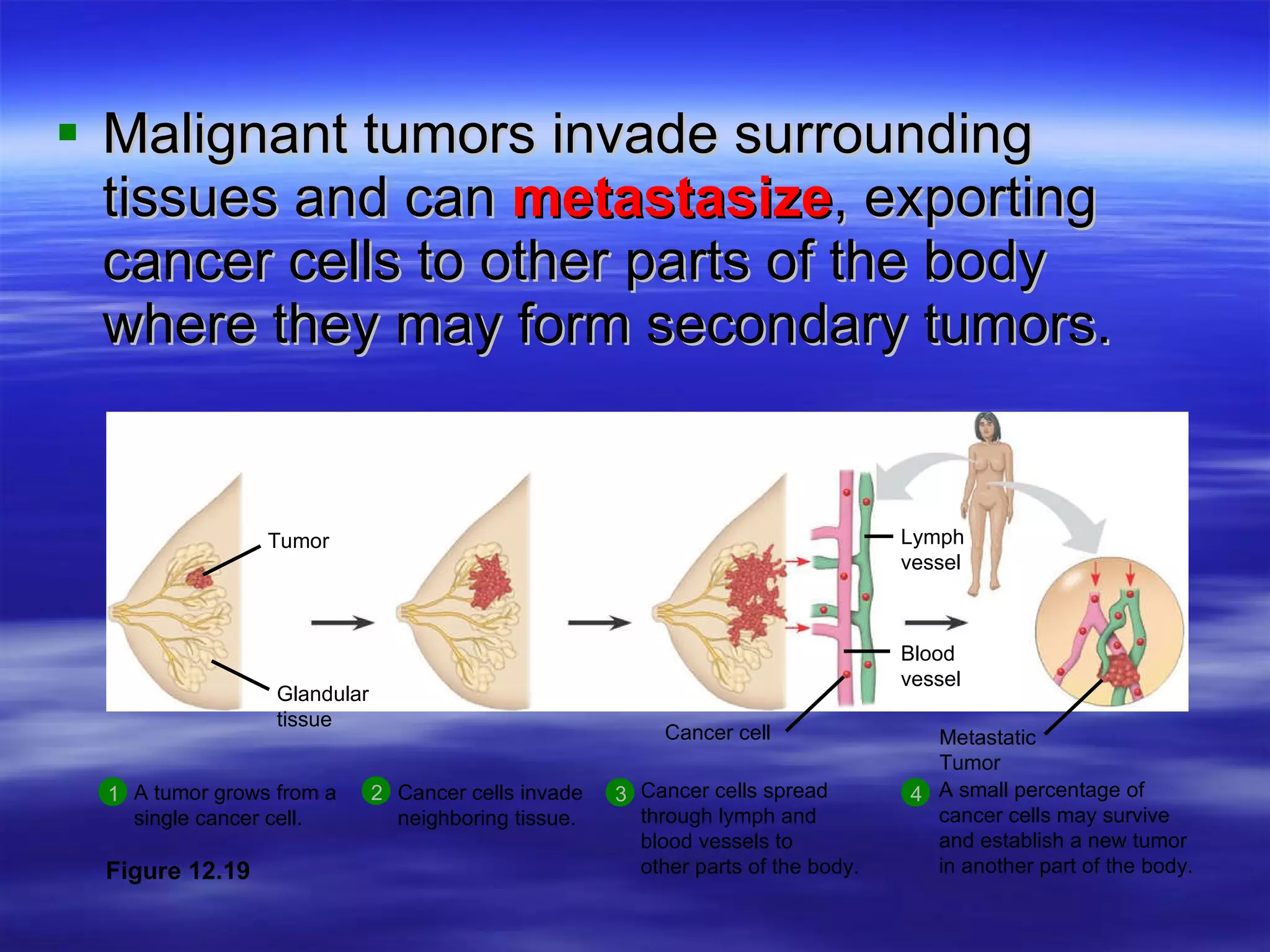 Malignant tumors invade surrounding tissues and can  metastasize , exporting cancer cells to other parts of the body where they may form secondary tumors. Figure 12.19 Cancer cells invade  neighboring tissue. 2 A small percentage of  cancer cells may survive  and establish a new tumor  in another part of the body. 4 Cancer cells spread  through lymph and  blood vessels to  other parts of the body. 3 A tumor grows from a  single cancer cell. 1 Tumor Glandular tissue Cancer cell Blood vessel Lymph vessel Metastatic Tumor 