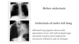 Before atelectasis

Atelectasis of entire left lung
Affected lung appears dense with
absorption of air; left half of diaphragm
elevated; trachea and mediastinal
structures shifted to side of collapse

 
