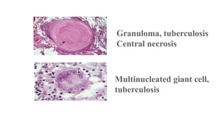 Granuloma, tuberculosis
Central necrosis

Multinucleated giant cell,
tuberculosis

 