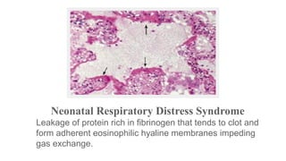 Neonatal Respiratory Distress Syndrome
Leakage of protein rich in fibrinogen that tends to clot and
form adherent eosinophilic hyaline membranes impeding
gas exchange.

 