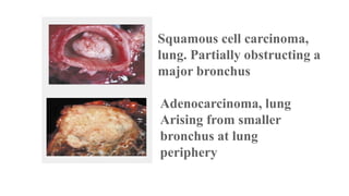 Squamous cell carcinoma,
lung. Partially obstructing a
major bronchus
Adenocarcinoma, lung
Arising from smaller
bronchus at lung
periphery

 