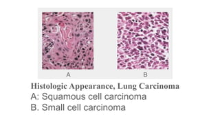 A

B

Histologic Appearance, Lung Carcinoma

A: Squamous cell carcinoma
B. Small cell carcinoma

 
