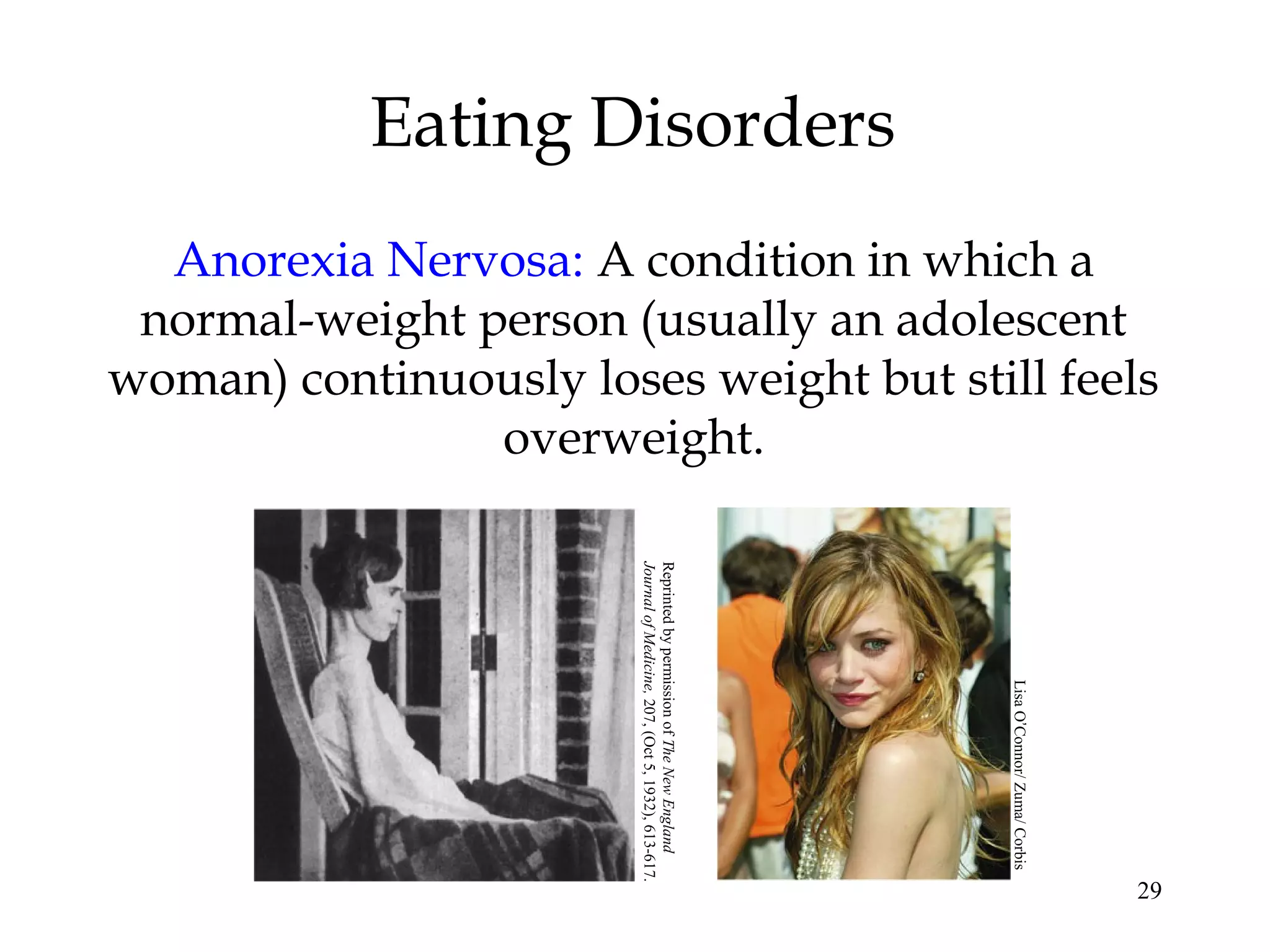29
Eating Disorders
Anorexia Nervosa: A condition in which a
normal-weight person (usually an adolescent
woman) continuously loses weight but still feels
overweight.
ReprintedbypermissionofTheNewEngland
JournalofMedicine,207,(Oct5,1932),613-617.
LisaO’Connor/Zuma/Corbis
 