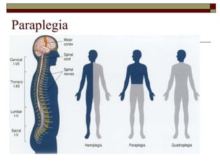 Paraplegia

 