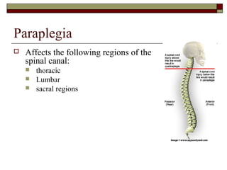 Paraplegia


Affects the following regions of the
spinal canal:




thoracic
Lumbar
sacral regions

 