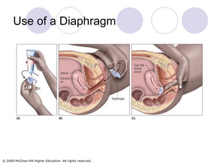 Use of a Diaphragm 
