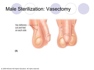 Male Sterilization: Vasectomy 