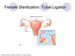 Female Sterilization: Tubal Ligation 
