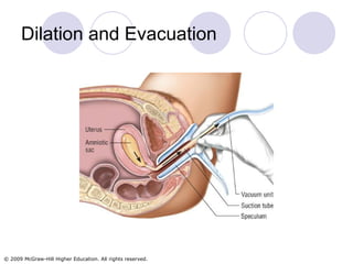 Dilation and Evacuation 