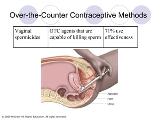 Over-the-Counter Contraceptive Methods 71% use effectiveness OTC agents that are capable of killing sperm Vaginal spermicides 