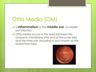 Otitis Media (OM)is inflammation of the middle ear, or middle ear infectionOtitis media occurs in the area between the tympanic membrane (the end of the outer ear) and the inner ear, including a duct known as the eustachian tube
