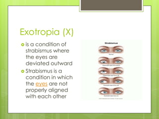 Exotropia (X)is a condition of strabismus where the eyes are deviated outwardStrabismus is a condition in which the eyes are not properly aligned with each other