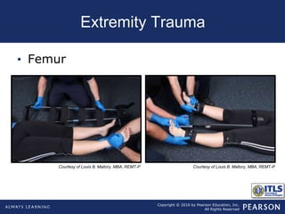 Chapter14 extremity trauma | PPT