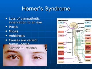 Horner’s Syndrome Loss of sympathetic innervation to an eye Ptosis Miosis Anhidrosis Causes are varied: tumor, aortic aneurism, trauma 