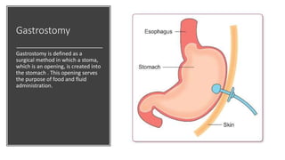 Gastrostomy
Gastrostomy is defined as a
surgical method in which a stoma,
which is an opening, is created into
the stomach . This opening serves
the purpose of food and fluid
administration.
 