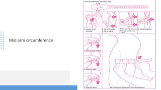 Mid arm circumference
 