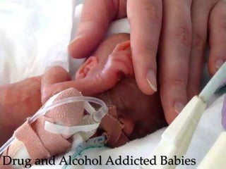 Drug and Alcohol Addicted Babies
 